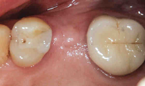 What can I eat after uncovering my implant?