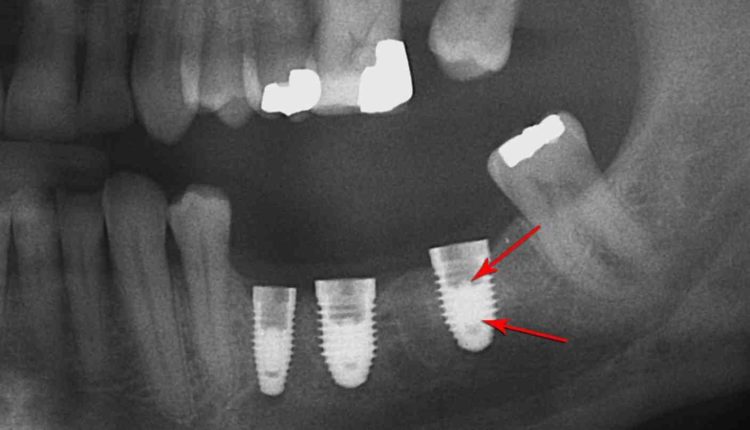 What can go wrong with dental implants