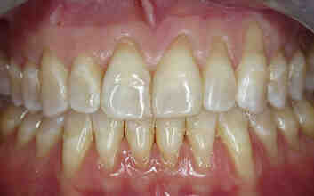 What can happen when an implant crown is cement retained?