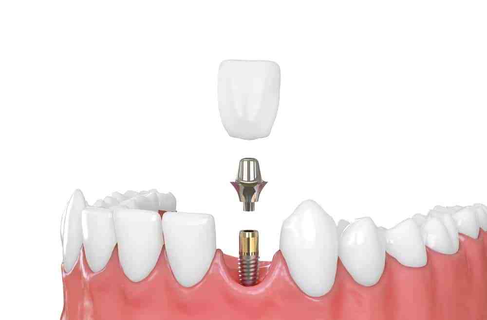 What can you eat after abutment?