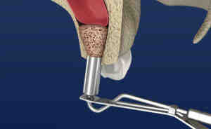 What can you not do after a sinus lift?