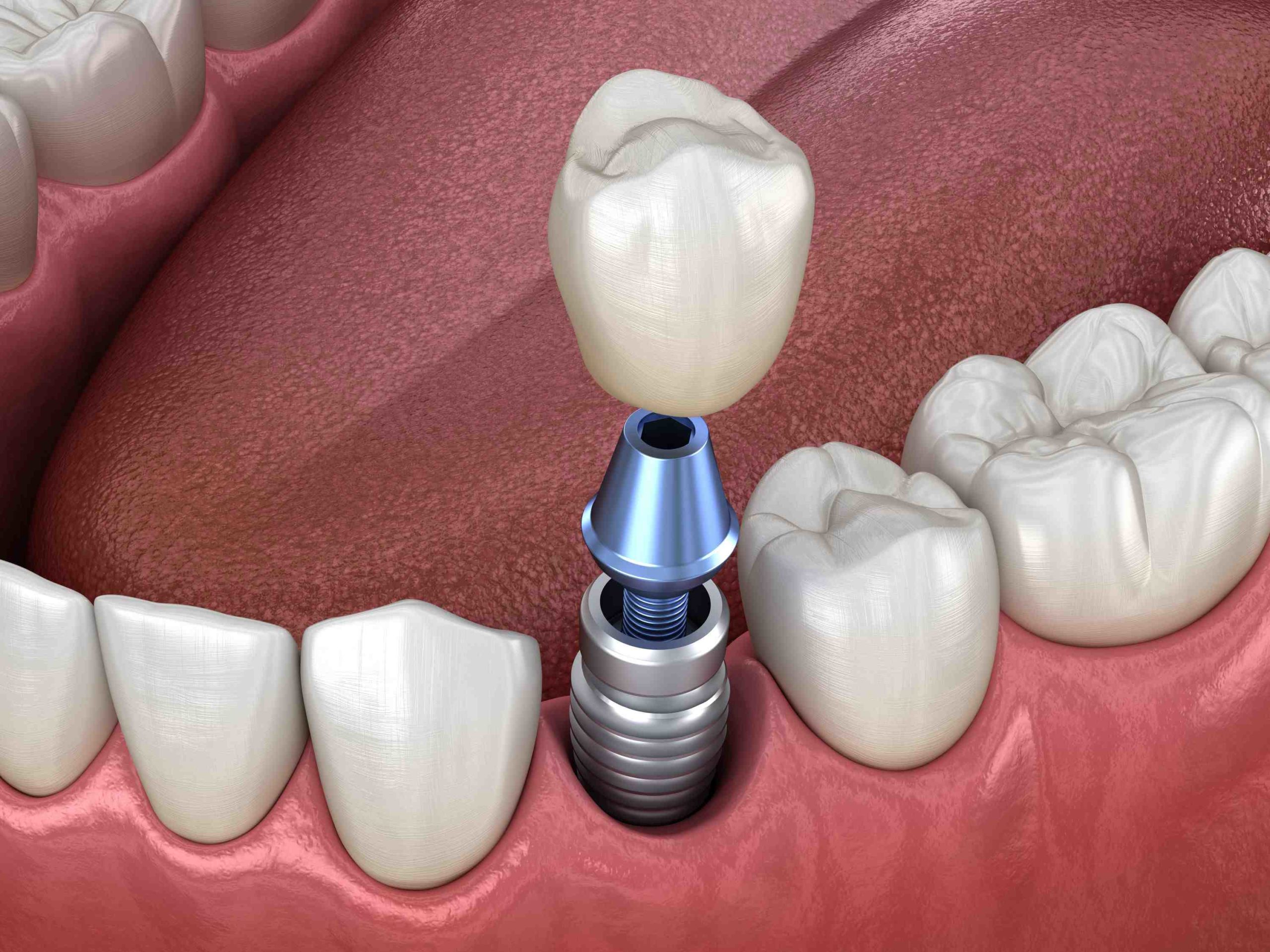 What can you not do after dental implants?