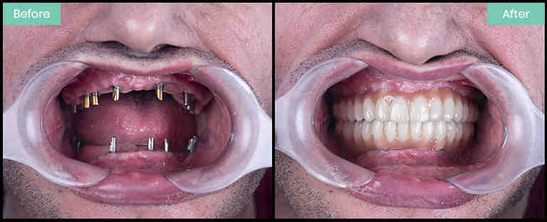 What can you not do after dental implants?