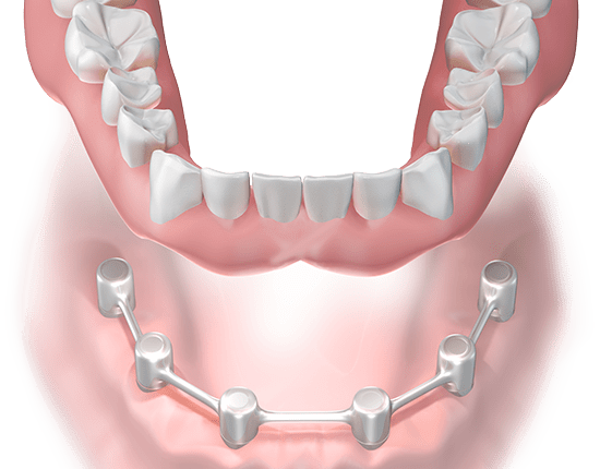What causes dental implants to loosen