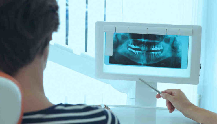 What causes the need for an dental implant