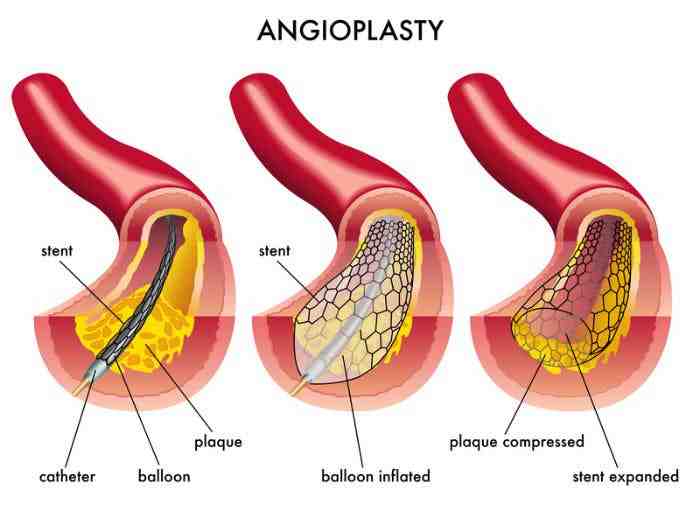 What dental procedures require antibiotic prophylaxis?