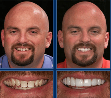 What did Miley Cyrus have done to her teeth?