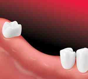 What disqualifies you from getting dental implants?