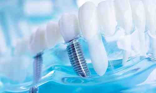What disqualifies you from getting dental implants?