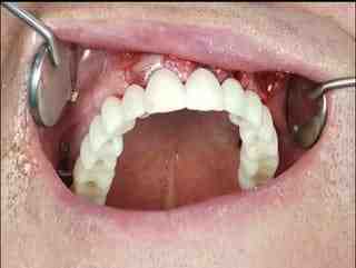 What do all on 6 implants look like?