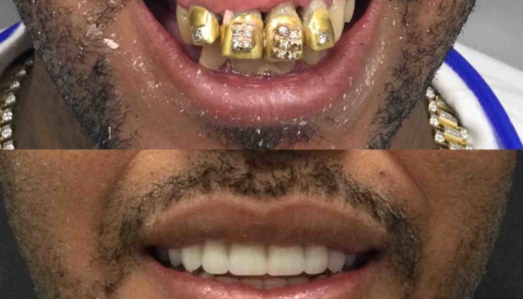 What do mini dental implants cost