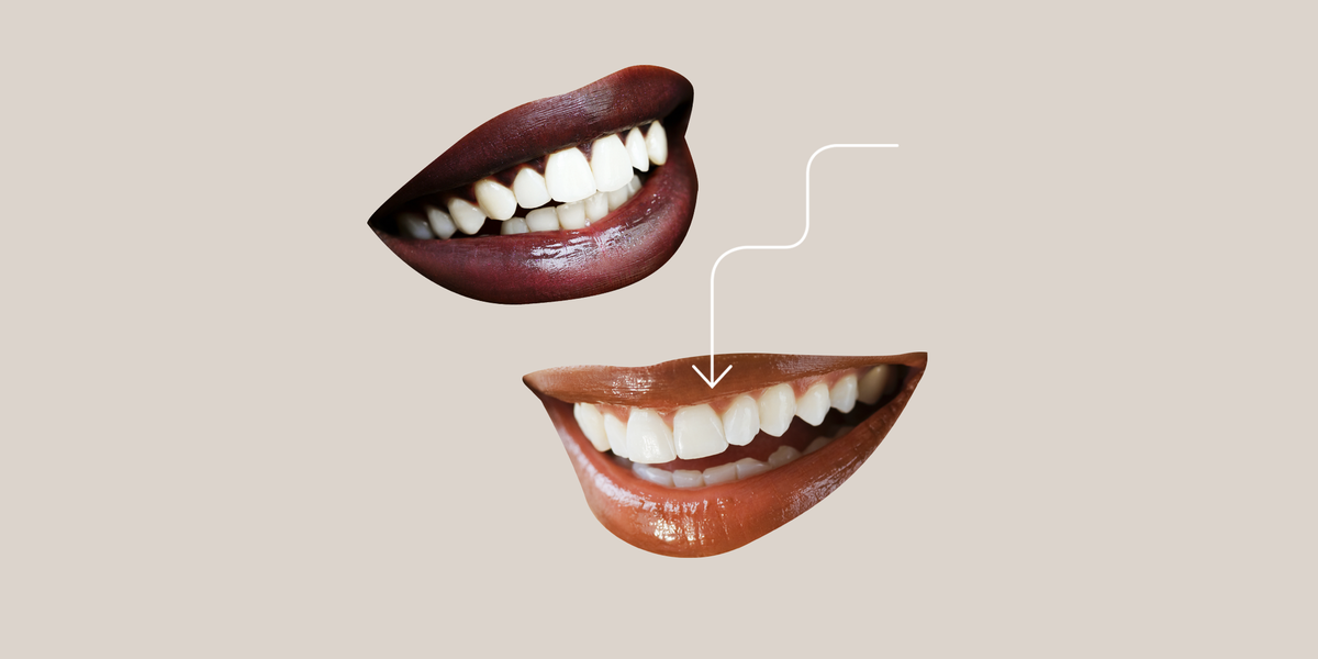 What do you do when all your teeth are bad?