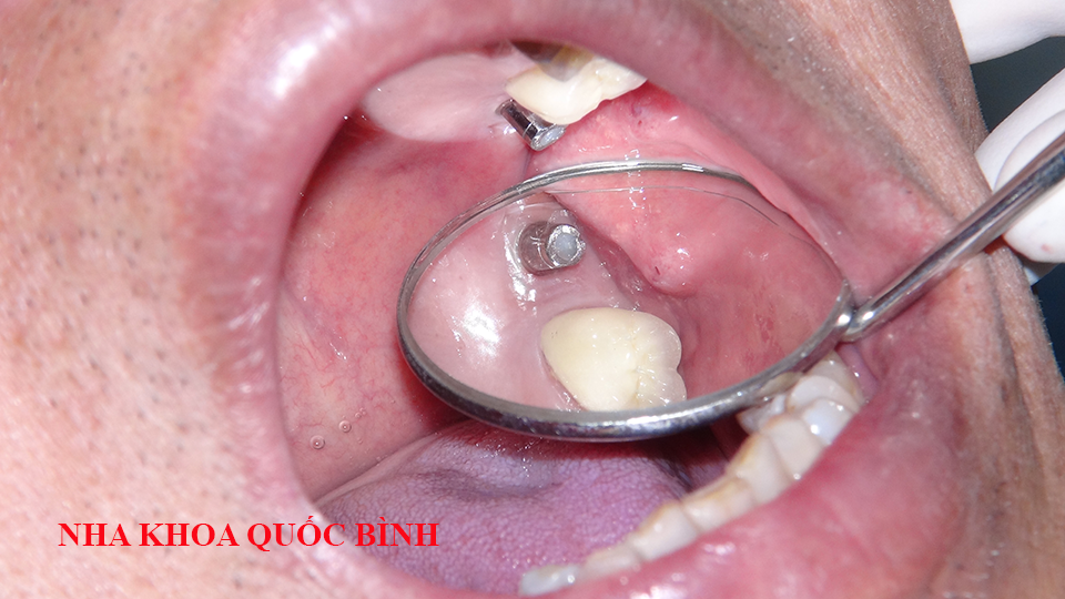 What does an implant infection look like?