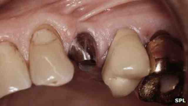 What does capsular contraction feel like?