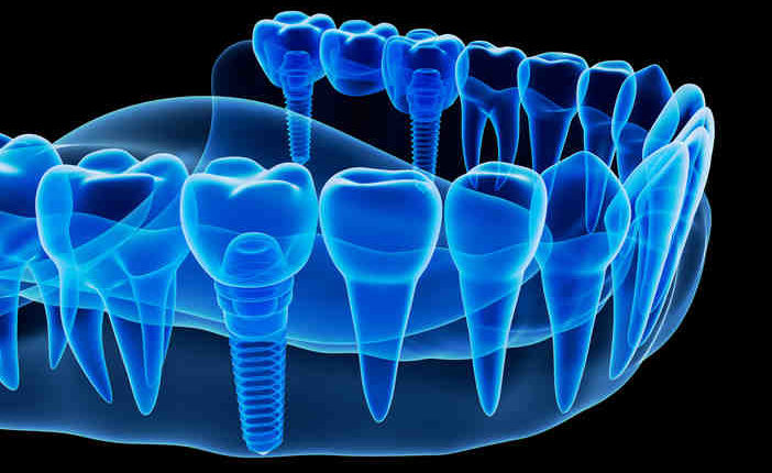 What foods you can have after dental implant surgery