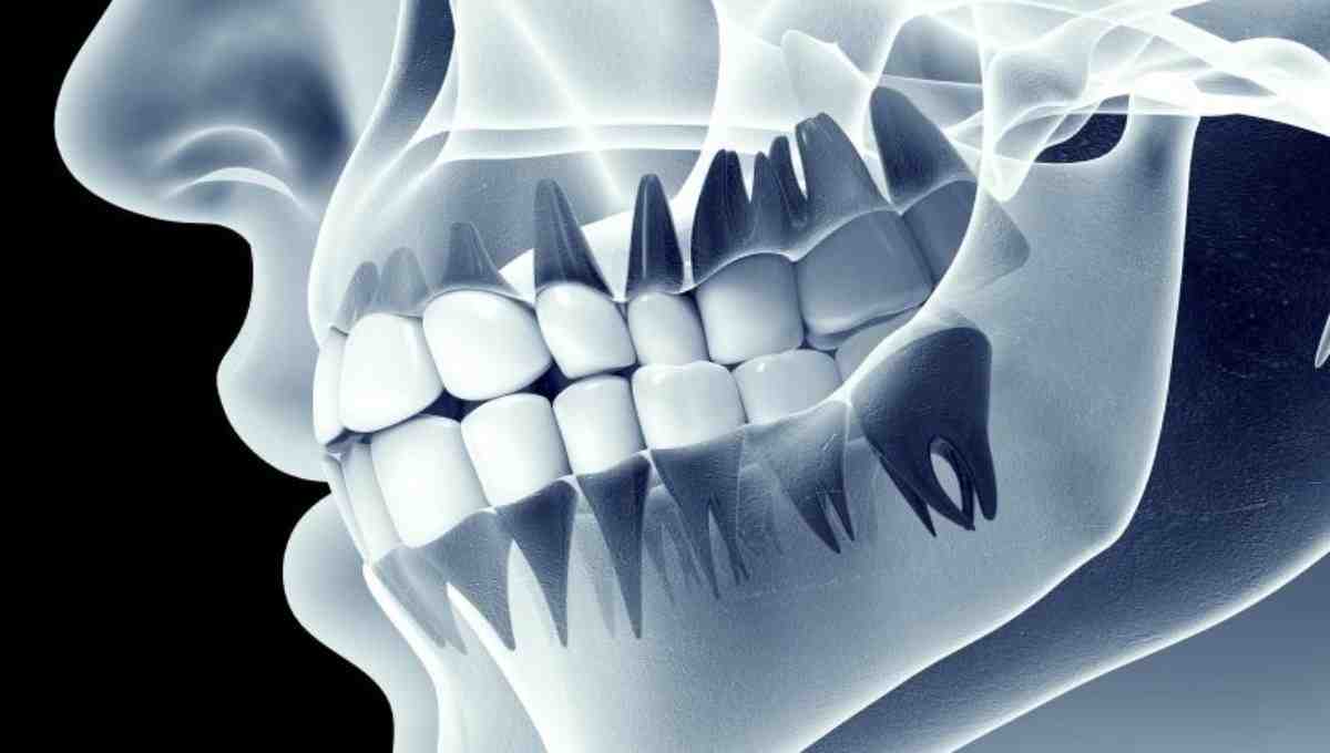 What happens if I don't get a bone graft after tooth extraction?