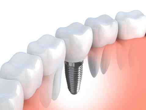 What happens if gum graft fails?