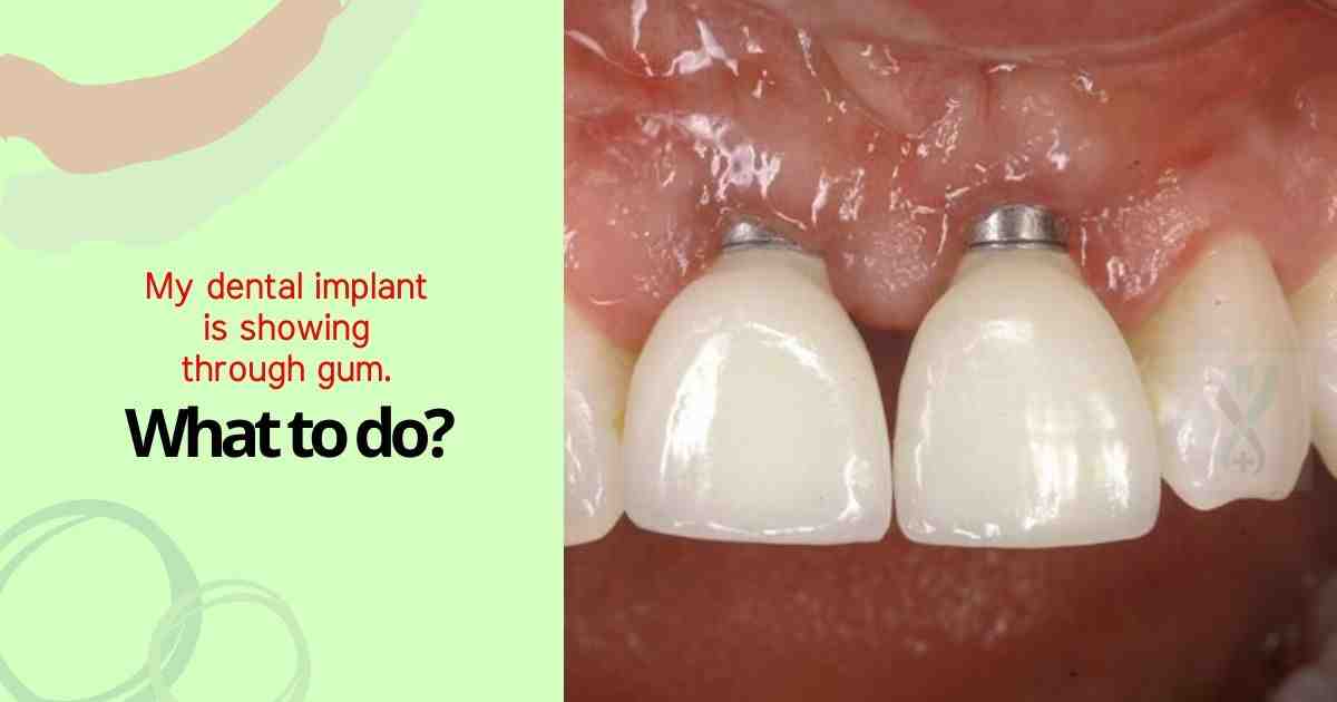 What happens if you don't get an implant after bone graft?