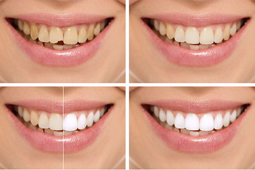 What happens to veneers after 15 years?