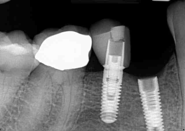 What happens when a dental implant gets loose?
