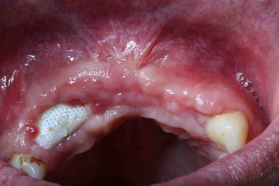What helps bone grafts heal faster?