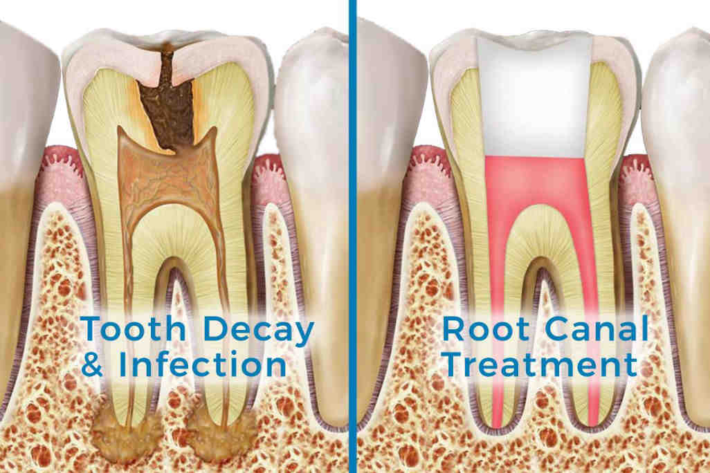What hurts more root canal or dental implant?