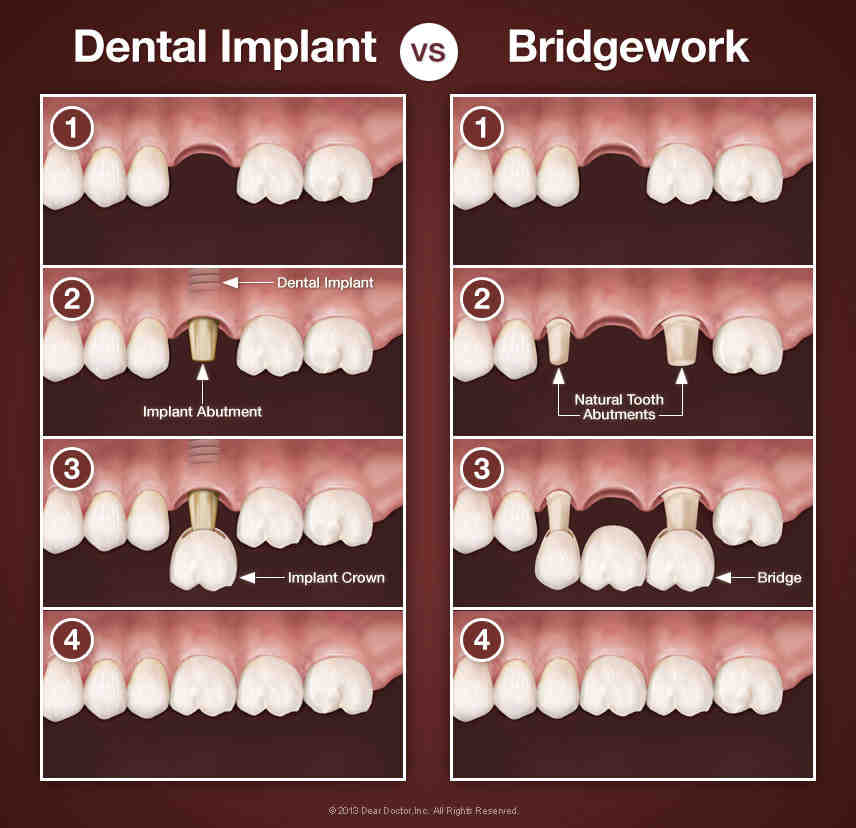 What hurts more tooth extraction or implant?