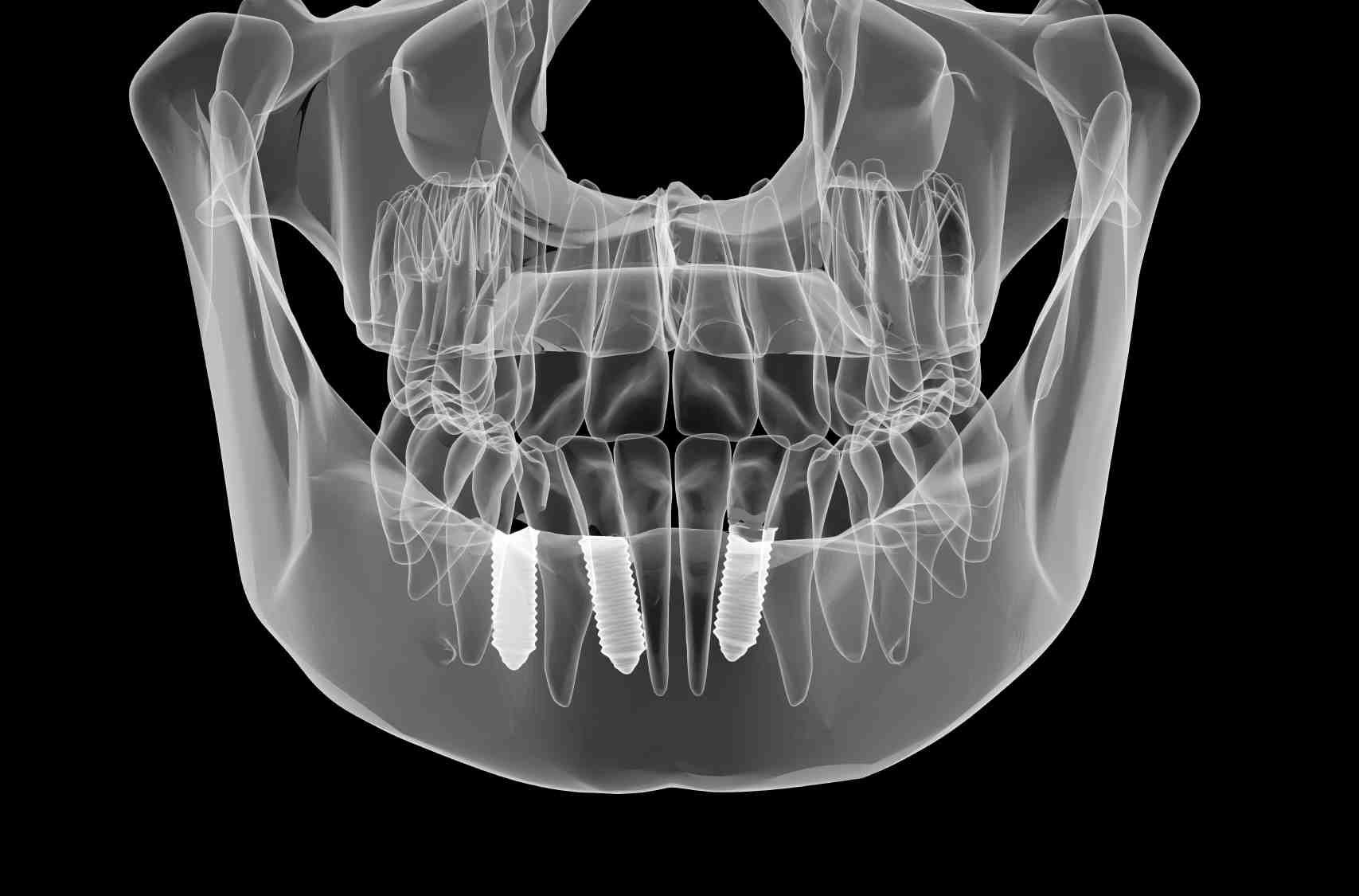 What hurts more tooth extraction or implant?