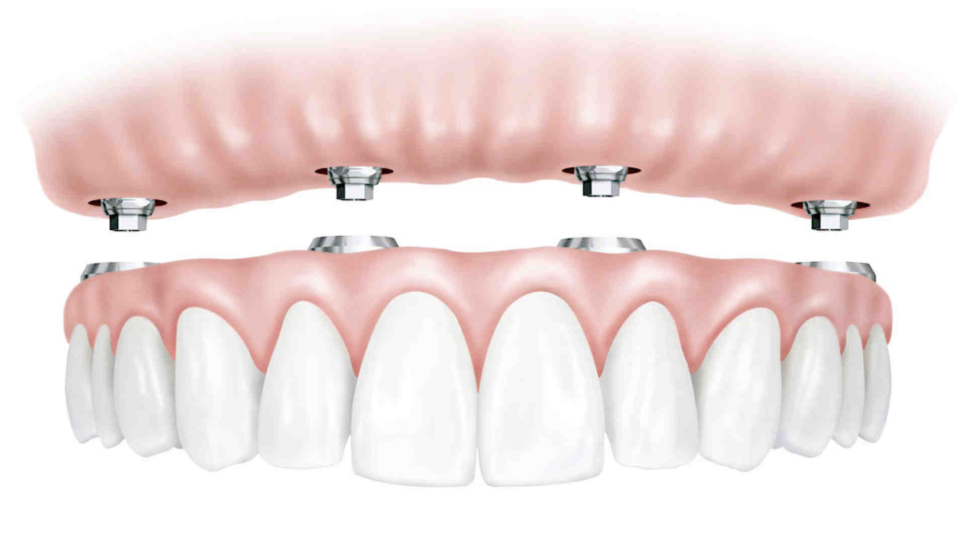 What hurts more tooth extraction or implant?