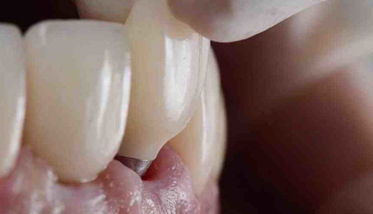 What if a dental implant fails