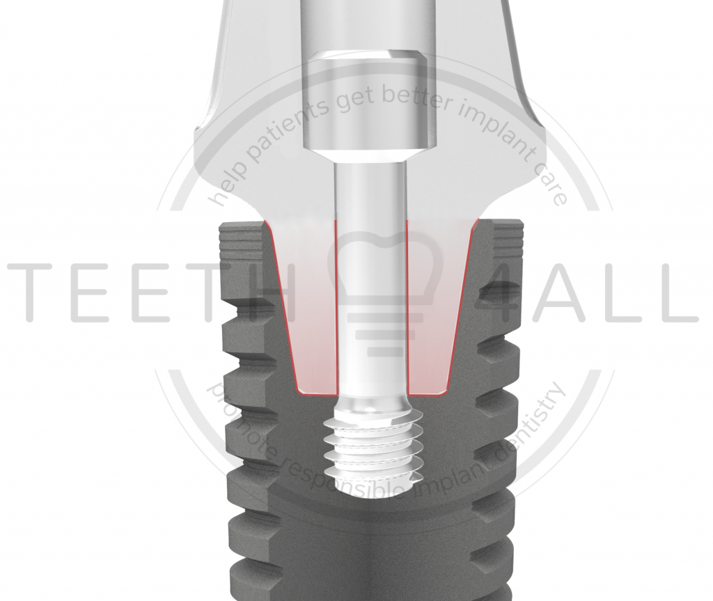 What implant is the most durable?
