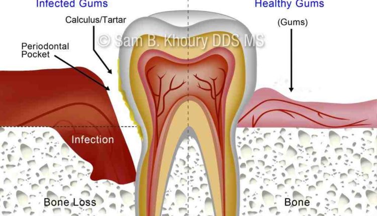 What infection is common with dental bone grafting for implants