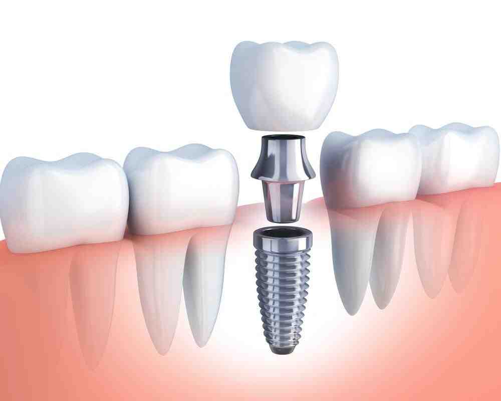 What is Stage 4 periodontal disease?