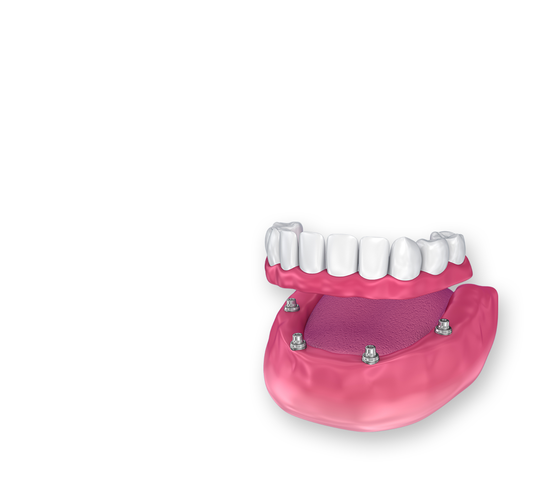 What is a bridge for teeth?