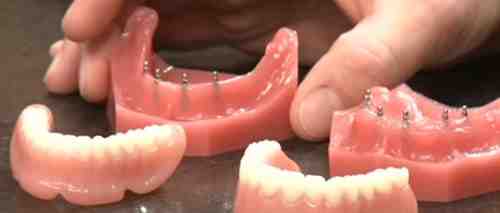 What is a cheaper alternative to a tooth implant?