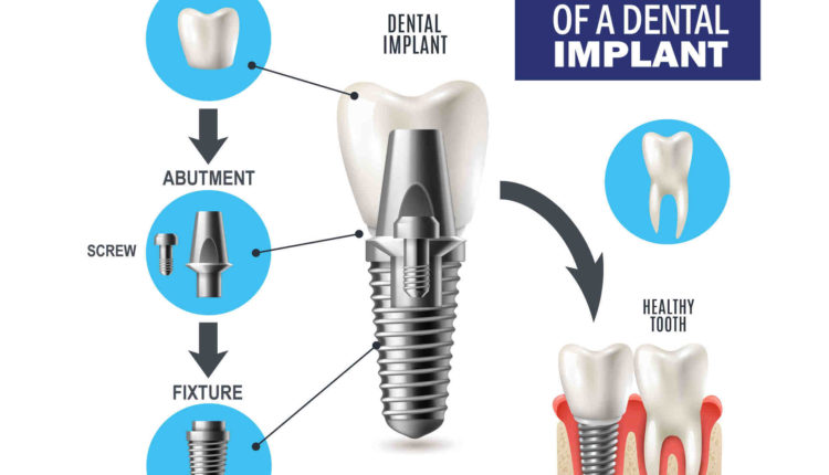 What is abutment in dental implant - Dental News Network