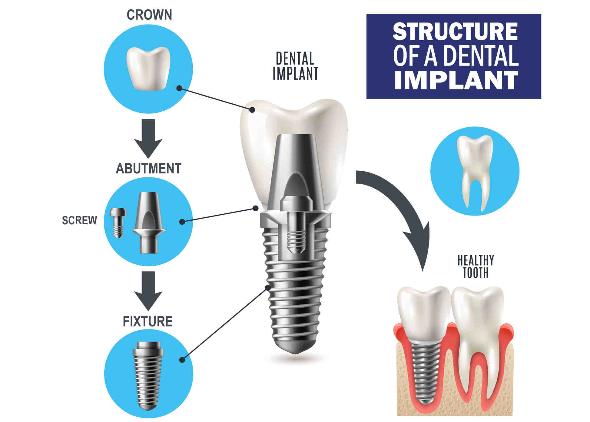 What is abutment in dental implant - Dental News Network