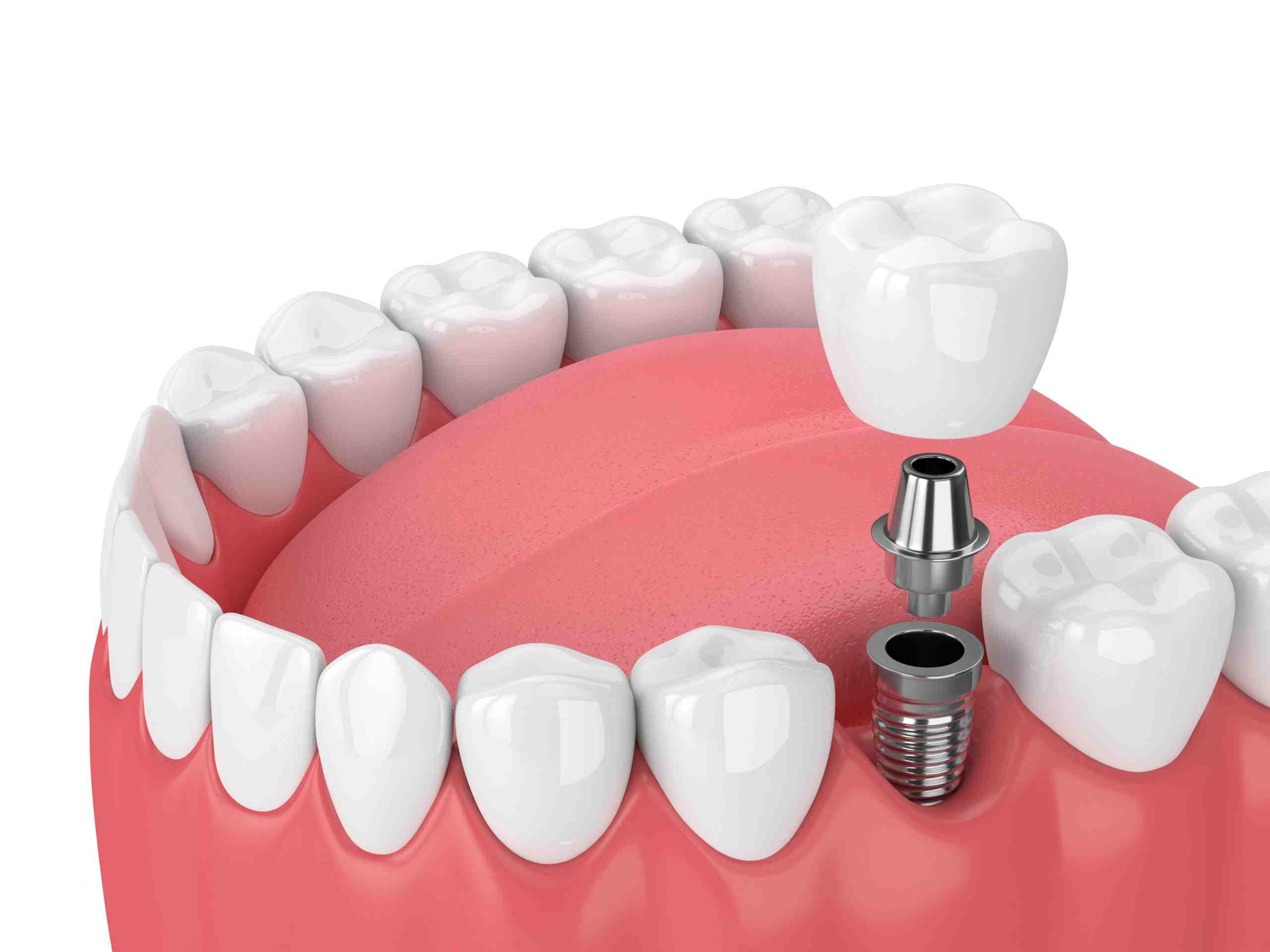 What is an alternative to a dental implant?