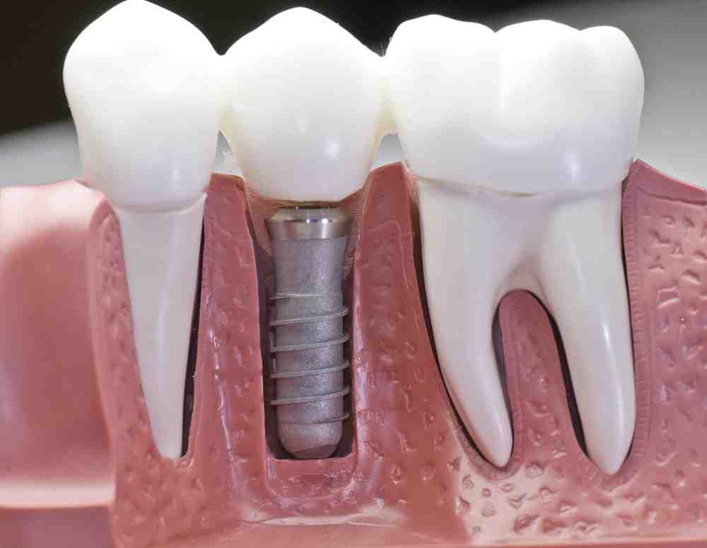 What is better a crown or an implant?