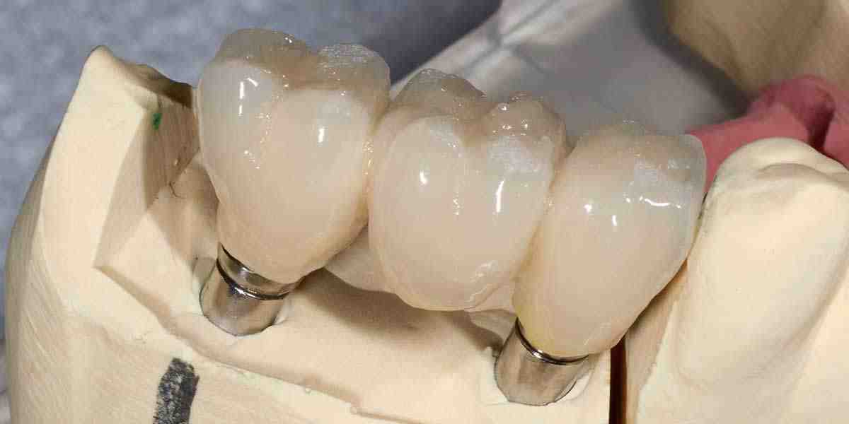 What is better implants or bridges?