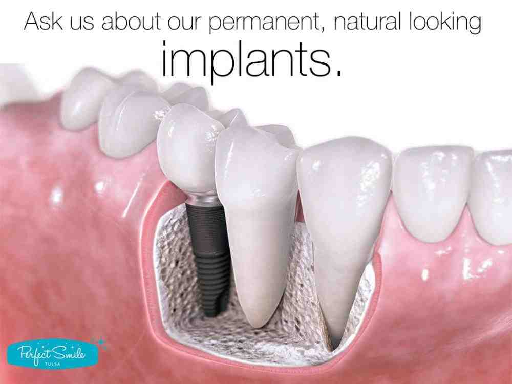 What is better root canal or implant?