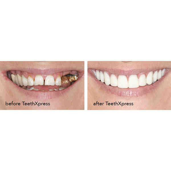 What is better root canal or implant?