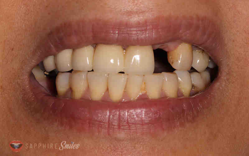 What is better root canal or implant?
