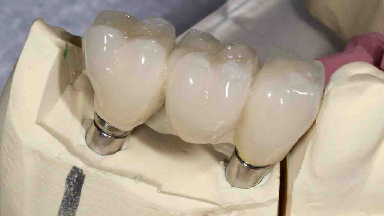What is final restoration for dental implants?