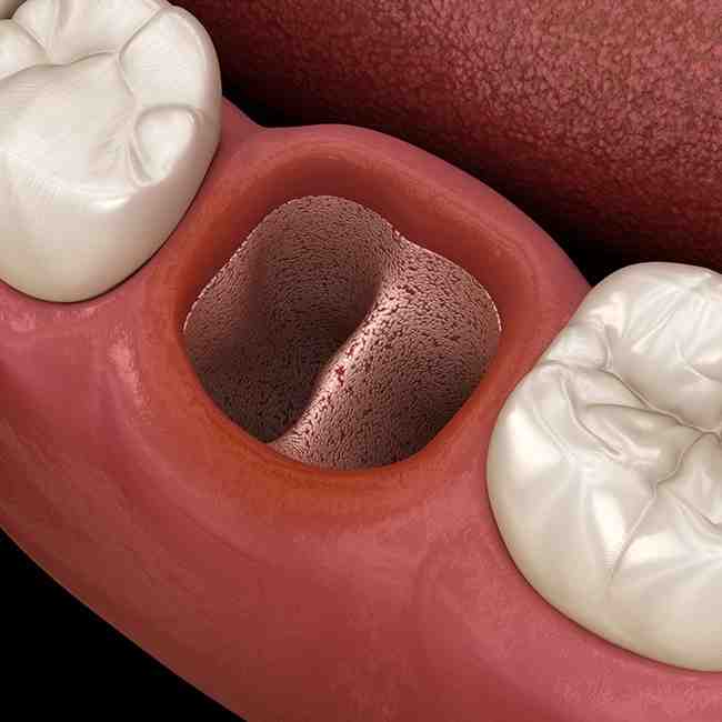 What is implant surgery?