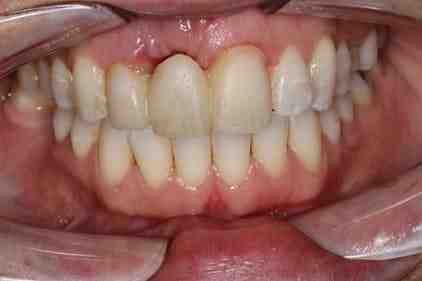 What is more painful bone graft or implant?