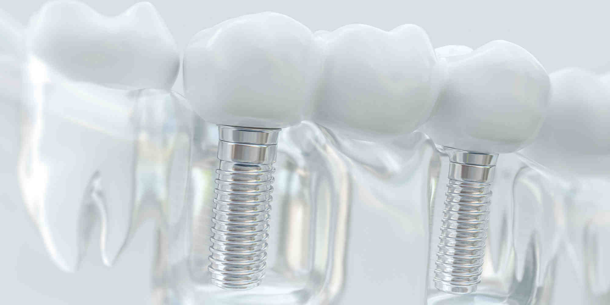 What is preparation for tooth implant?