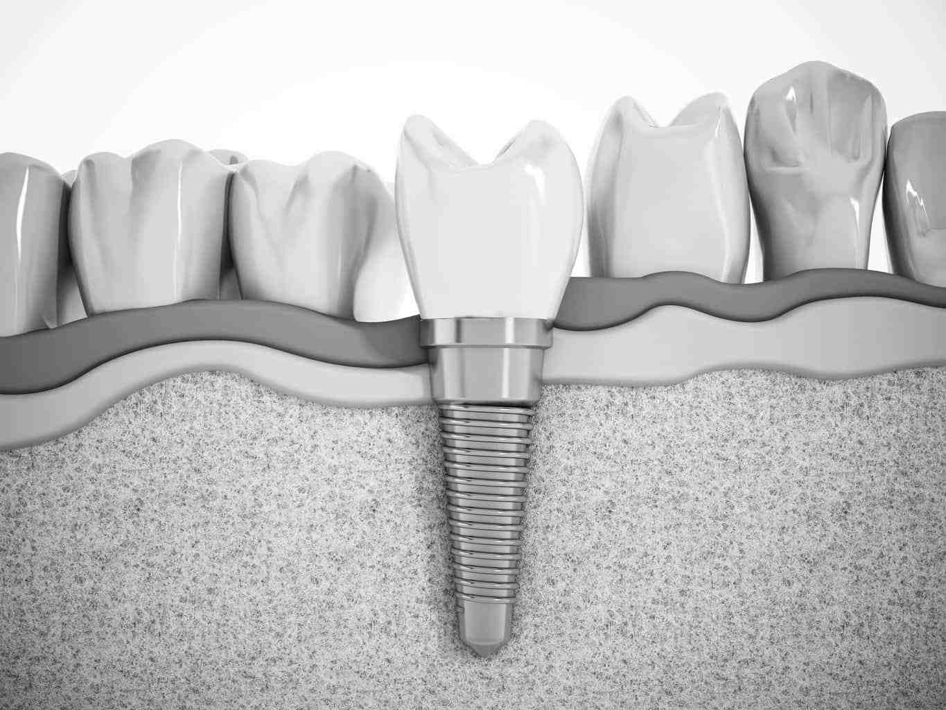 What is the average age for implants?