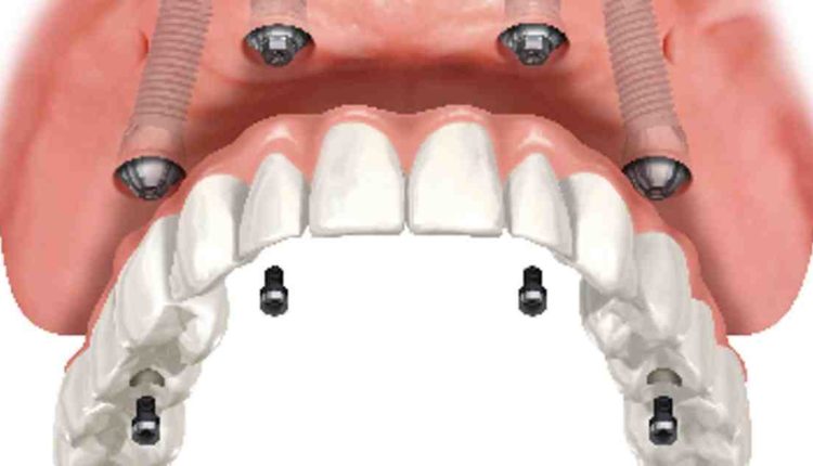 What is the average cost for a four post dental implant