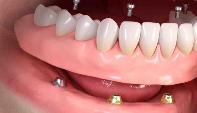 What is the average price for a full set of dental implants